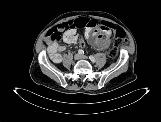 CT scan with a suspicious mass near the small bowel.