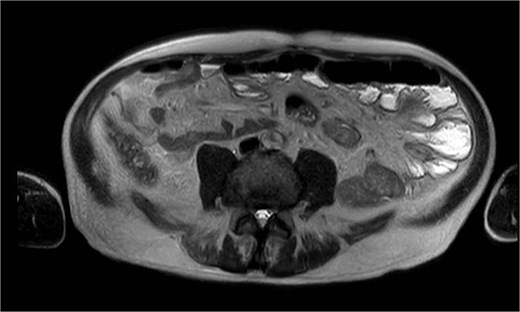 MRI showing multiple jejunal diverticula on the mesenteric side.