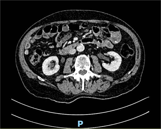 CTA with venous bleeding in the jejunum.