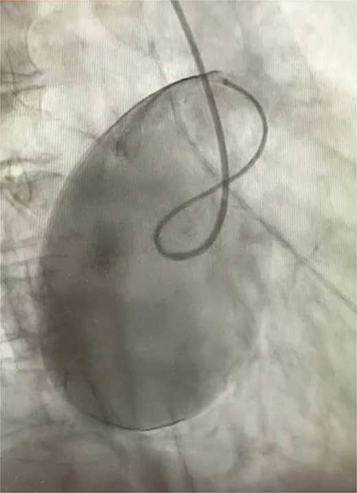 Right coronary angiogram highlighting the aneurysm.