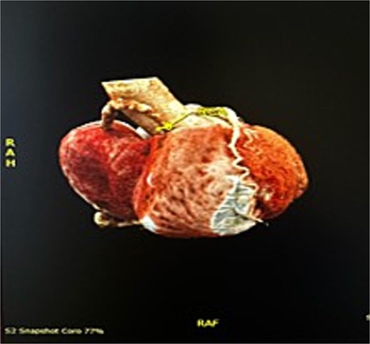 3D reconstruction from CT thorax showing the right coronary aneurysm compressing right heart.