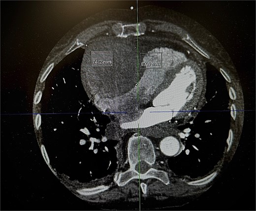 Axial plane of a contrast thorax CT scan showing the giant right coronary aneurysm.
