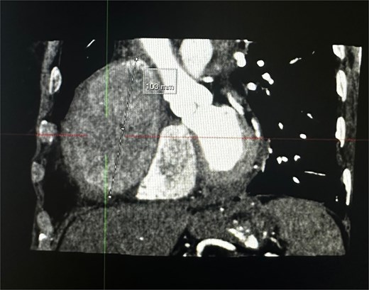 Coronal plane of a contrast thorax CT scan showing the giant coronary aneurysm.