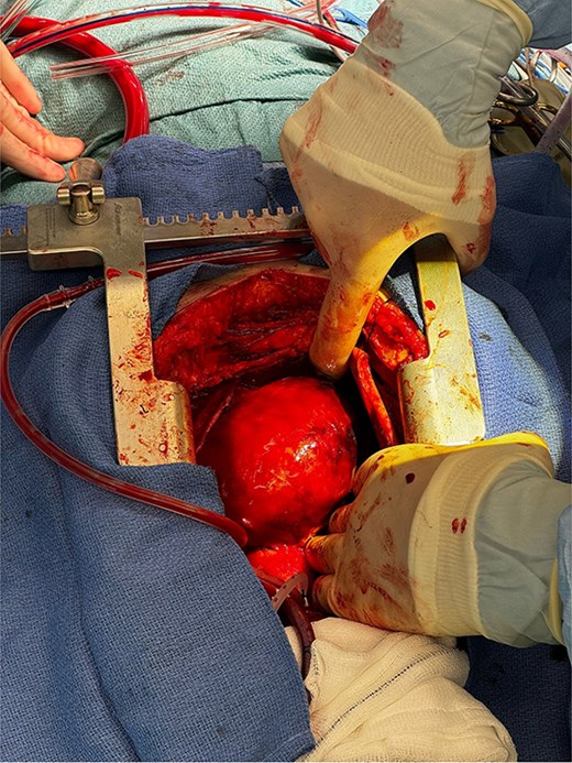 Exposed right coronary aneurysm post sternotomy.