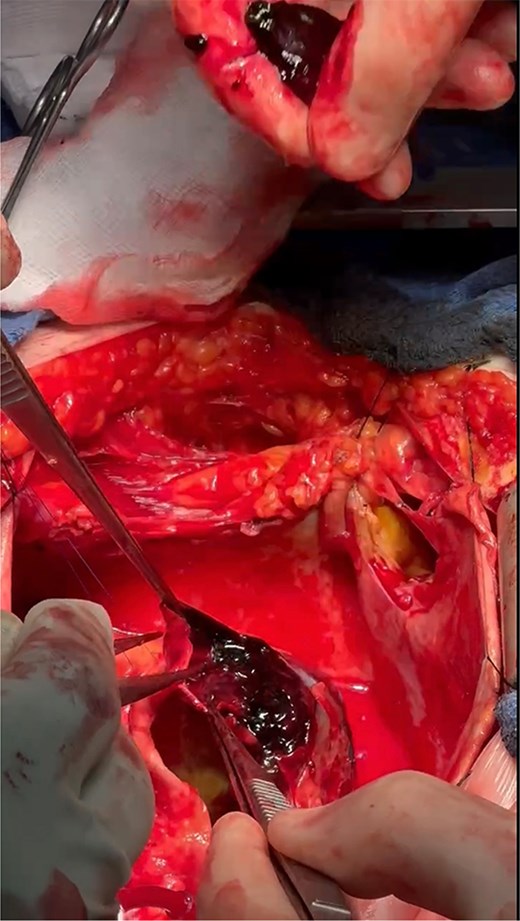 Dissected aneurysm wall with thrombus formation.