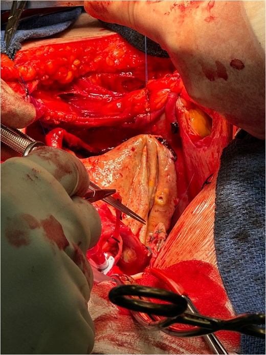 Direct anastomosis of saphenous conduit to the distal neck of the aneurysm using an end-to-end technique.