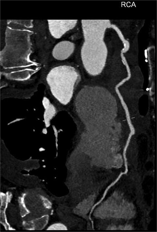Reconstructed path of right coronary artery including vein graft via aneurysmal sac from post-operative CT coronary angiogram.