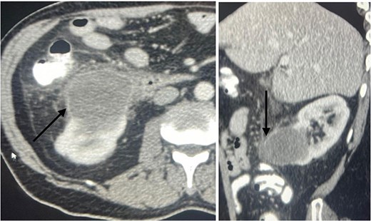 An axial view (on the right) and sagittal view (on the left) showing a ring enhancing lower pole cyst (arrow), suggesting infected cyst vs abscess formation.