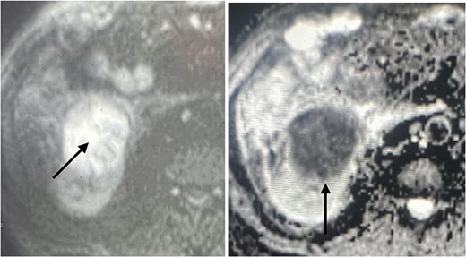 DWI- ADC map shows strong internal restricted diffusion which can present in both abscess as well as tumor (arrow).