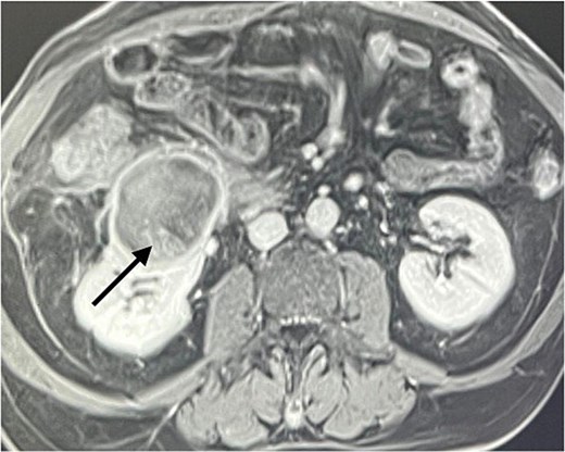 T1 post contrast showing a ring enhancing cystic lesion in the lower pole with fine internal enhancement (arrow).