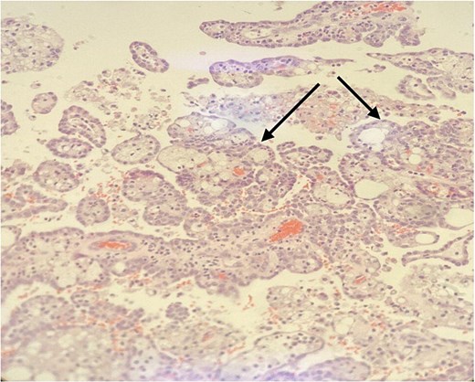 Papillary structures with fibrovascular core (arrow) lined by low grade tumor cells. H&E stain, 100×.