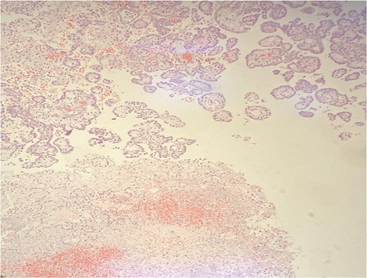 Diffuse tumor necrosis in the lower field. H&E stain 40×.