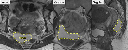 Preoperative pelvic MRI showing the recurrent retroperitoneal tumor (dashed line). Axial view: The tumor is located posterior to the uterus and anterior to the rectum. Coronal view: The tumor extends horizontally across the pelvic cavity. Sagittal view: The tumor is situated between the bladder and rectum, occupying the posterior pelvic space.