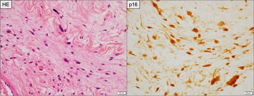 Histopathological findings of the primary retroperitoneal tumor. Left: Hematoxylin and eosin (HE) staining showing spindle-shaped atypical cells with abundant collagenous stroma suggestive of WDLPS. Right: Immunohistochemical staining for p16, demonstrating diffuse nuclear and cytoplasmic positivity in tumor cells. Scale bar = 20 μm.