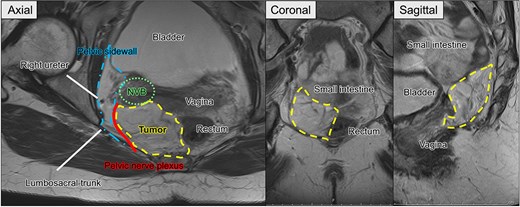 Preoperative pelvic MRI showing the extent and anatomical relationships of the recurrent tumor (dashed line). Axial view: The tumor is located adjacent to the rectum and vagina, abutting the pelvic sidewall (dash-dotted line), neurovascular bundle (NVB) (dotted line), pelvic nerve plexus (solid line), and right ureter. Coronal and sagittal views. The tumor is observed near the small intestine, rectum, bladder, and vaginal stump.