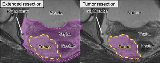 Comparison of surgical options based on preoperative MRI. Left (extended resection): The hypothetical resection area (dotted line) includes the tumor (dashed line), rectum, and vagina, corresponding to the multivisceral resection approach. Right (tumor resection): Planned organ-preserving resection where the tumor is delineated in yellow, and the surrounding organs are preserved.
