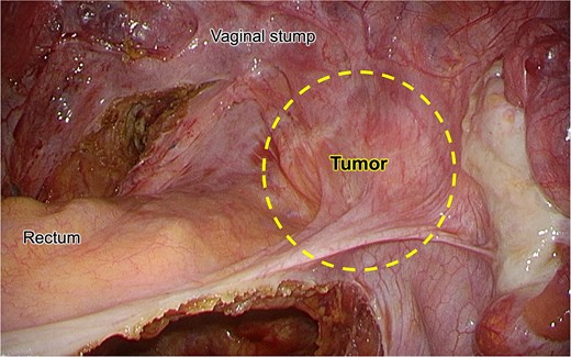 Intraoperative laparoscopic view showing the recurrent tumor (dashed line) located at the right lateral aspect of the rectum. The tumor is closely attached to the vaginal stump and surrounded by fibrous tissue, without a clear dissection plane.