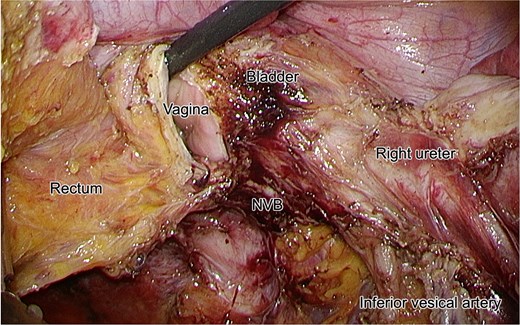 Intraoperative laparoscopic view following dissection of the tumor. The right ureter is isolated and preserved. The NVB, bladder, vagina, rectum, and inferior vesical artery are clearly identified.