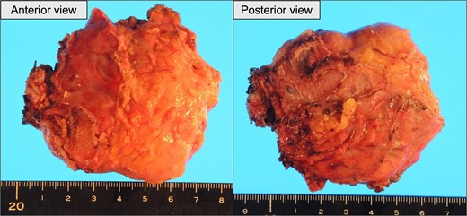 Gross appearance of the resected tumor. Left: Anterior surface. Right: Posterior surface.