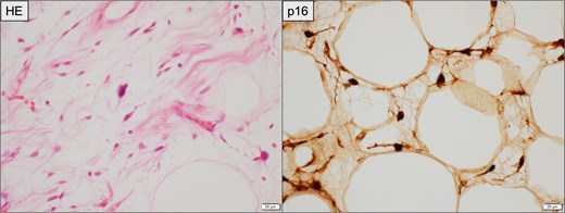 Histopathological findings of the resected recurrent tumor. Left (HE staining): Atypical spindle-shaped cells with hyperchromatic nuclei are observed within the fibrous stroma, consistent with WDLPS. Right (immunohistochemistry for p16): Tumor cells demonstrate diffuse nuclear and cytoplasmic positivity. Scale bar = 20 μm.