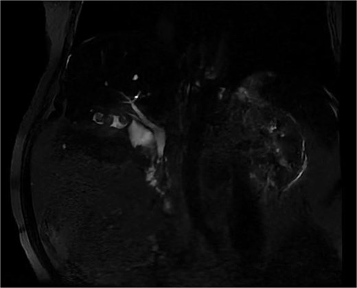 Biliary MRI showing an image mimicking a double gallbladder with a single cystic duct and an intravesicular macrolithiasis.