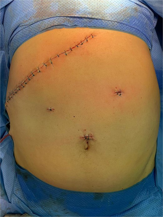 Subcostal approach after conversion.