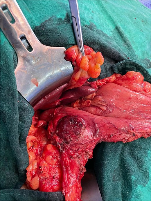 Intraoperative view showing cholecystitis of a sclerotic and atrophic gallbladder associated with a cholecysto-gastric fistula.