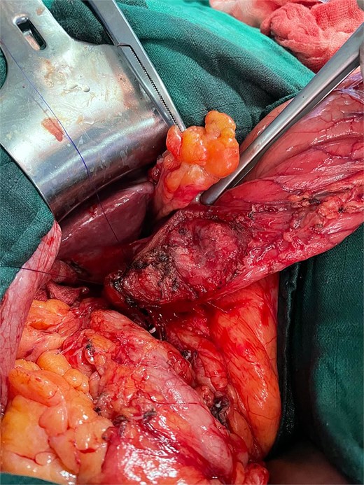 Intraoperative image after resection of the gallbladder and the subserosal gastric cyst.