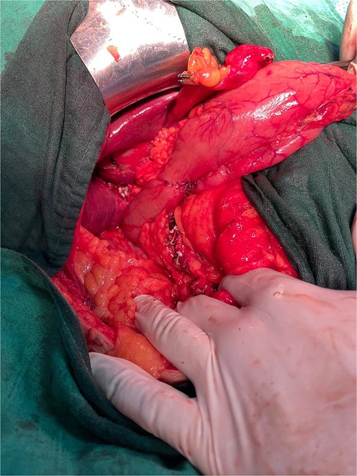 Closure of the gastric wall.
