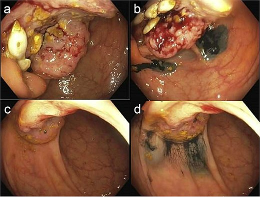 Colonoscopic imaging of cecal mass before biopsy/tattoo (a) and after (b). Colonoscopy imaging of hepatic flexure mass before biopsy/tattoo (c) and after (d). Note: Histologic or gross specimen images are not available for this case.