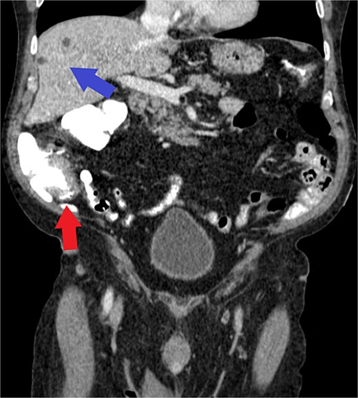 Axial view of CT demonstrating cecal wall thickening (red arrow) and benign hepatic cysts (blue arrow) without evidence of metastatic disease. Note: Histologic or gross specimen images are not available for this case.