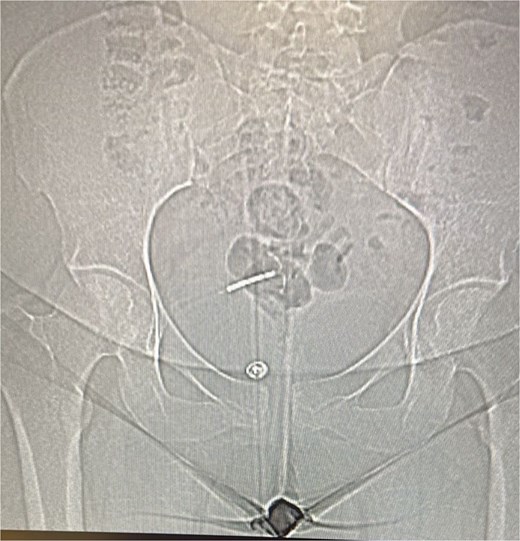 A plain abdominal X-ray was performed, which visualize the IUD with suspicion for its extrauterine location.