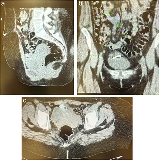 (a–c) The CT scan revealed the IUD embedded between the anterior abdominal wall and urinary bladder with a small, localized fluid collection suggestive of an abscess.