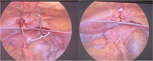 Demonstrates the intraoperative findings during diagnostic laparoscopy. The IUD is visualized embedded in the anterior abdominal wall, surrounded by inflamed tissue consistent with a localized abscess. This confirms the diagnosis of uterine perforation and extrauterine migration of the IUD.