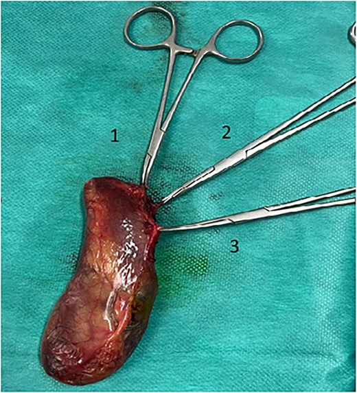 Cholecystectomy specimen showing the three elements: Cystic artery (3) and two cystic ducts (1, 2).