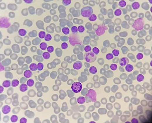Peripheral blood smear showing abnormal lymphocytes with numerous gumprecht shadows.
