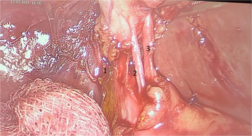 Intraoperative image showing three elements: Cystic artery (3) and two cystic ducts (1, 2).