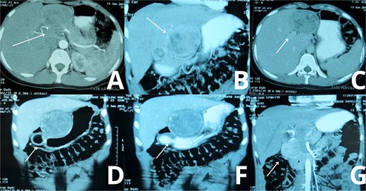 Abdominal CT imaging suggestive of gossypiboma. Contrast-enhanced abdominal CT scans of the patient demonstrate a well-defined, heterogeneous mass located in the upper abdomen, specifically in hepatic segment 3. (A, C) Axial views reveal internal air foci and a linear radiopaque marker, highly suggestive of a retained surgical sponge (gossypiboma). (B) A transverse section further supports the presence of a foreign body, with peripheral enhancement and absence of internal contrast uptake. (D, F, G) Wider axial slices show the spatial relationship of the mass with surrounding hepatic and gastric structures, confirming its intrahepatic location and size (~10 cm), without evidence of ascites or other hepatic lesion.