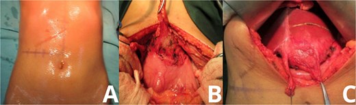 Intraoperative exposure of intrahepatic gossypiboma. Photographs taken during exploratory laparotomy document the identification and mobilization of the gossypiboma. (A) Initial intra-abdominal view reveals dense adhesions between the round ligament and lesser curvature of the stomach. (B, C) Progressive dissection exposes a fibrous, well-encapsulated mass within hepatic segment 3. The mass is separated from surrounding structures with careful technique, avoiding injury to adjacent organs.