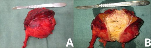 Gross specimen of explanted gossypiboma. Post-resection images of the excised mass show its characteristic features. (A) Lateral view displays the fibrotic outer capsule enveloping the retained surgical sponge. (B) Opposing view highlights the gauze fibers and associated tissue reaction, confirming the diagnosis of textiloma upon histological examination.