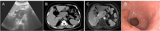 Preoperative imaging and endoscopic findings. (A) Abdominal ultrasound identified a space-occupying lesion located in the upper abdominal region. (B) Abdominal CT scan reveals a mass located in the head of the pancreas. (C) 3.0T MRI with contrast enhancement revealed a mass located in the pancreatic head, indicating a potential malignant lesion. (D) Electronic gastroscopy showed chronic atrophic gastritis and antrum bulge.