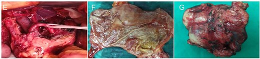 Intraoperative and gross pathological findings. (E) Intraoperative anatomical assessment revealed that the group 8 lymph nodes were densely adherent to the pancreatic parenchyma and adjacent vascular structures. (F) Gastric cancer tissue. (G) The surgically resected mass is located in the group 8 lymph node compartment.
