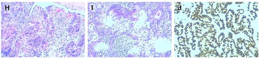Histopathological and immunohistochemical analysis (×200 magnification). (H) The preoperative gastroscopic biopsy immunohistochemistry (×200) results were highly suspicious for malignancy. (I) Immunohistochemical analysis of the resected gastric carcinoma specimen (×200) supports the diagnosis of early gastric cancer. (J) Histopathological evaluation of the resected specimen confirmed metastatic involvement of the lymph node tissue (×200).
