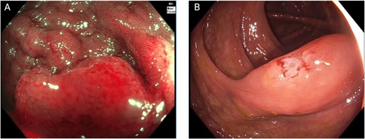 Colonoscopic findings. (A) Near-focus narrow-band imaging showing a prominent, nodular subepithelial lesion measuring ⁓30 mm, with disrupted mucosal architecture, erythema, and loss of surface vascular pattern—features suggestive of acute mucosal infiltration. (B) Conventional white-light endoscopy demonstrating smooth, elevated mucosa with focal congestion and superficial linear disruption, corresponding to the area of the subepithelial lesion.