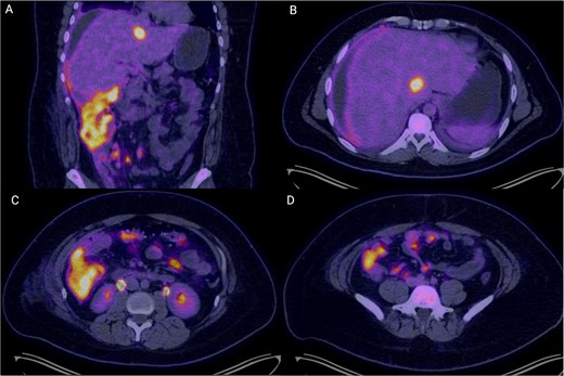 PET-CT images demonstrating extensive hypermetabolic abdominal disease. (A) Coronal image showing circumferential mural thickening of the right colon with intense FDG uptake (SUVmax 20.0), suggestive of transmural neoplastic infiltration, alongside multiple peritoneal implants and mesenteric hypermetabolism. (B) Axial slice at the hepatic level revealing a hypodense, hypermetabolic lesion in segment VI of the liver (SUVmax 19.8), consistent with a secondary metastatic deposit. (C) Axial mid-abdominal view showing abnormal FDG uptake in mesenteric and pericolonic regions, with nodular foci consistent with lymphadenopathy and peritoneal seeding. (D) The inferior axial section depicts multiple hypermetabolic foci along the peritoneum, indicative of diffuse peritoneal involvement. These findings are consistent with metabolically active, disseminated abdominal disease in keeping with a diagnosis of high-grade lymphoma.