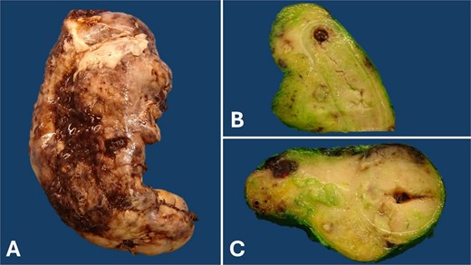 Gross pathology of the appendix: The serosal surface of the appendix appears brown, with fibrinopurulent plaques (A). Longitudinal (B) and cross (C) sections reveal obliteration of the appendiceal lumen by a diffusely growing, bulging, soft, and white tumor involving the entire appendiceal wall and mesoappendix. This appearance is often described as a ‘fish flesh’ appearance.