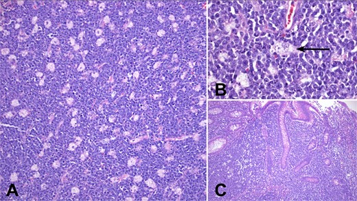 Microscopic tumor morphology: (A) In sections stained with H&E, the tumor shows a starry sky pattern composed of monomorphic medium-sized neoplastic lymphocytes and clear tingible body macrophages (100×). (B) Lymphocytes make the sky while tingible body macrophages (arrow) the sky of the starry sky pattern. Neoplastic lymphocytes exhibit a round nucleus, basophilic nucleoli, basophilic cytoplasm, and squared-off membranes (200×). (C) The lymphoma invades the appendiceal mucosa (100×).