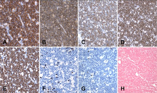 Immunohistochemistry panel (A–G) and in situ hybridization (H): Neoplastic cells exhibit diffuse membrane positivity for CD20 (A) and CD10 (B). Nuclear positivity is observed with the markers BCL6 (C) and c-MYC (D). Proliferation index measured with Ki67 (MIB1) is close to 100%; only scarce lymphocytes and macrophages are negative for MIB1 (E). CD5 (F) is negative in lymphoma cells, and only a few scattered reactive T cells are positive. BCL2 (G) is negative. Finally, in situ hybridization for Epstein–Barr virus, EBER (H), is completely negative in this case.