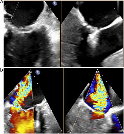 Transesophageal echocardiography following the MitraClip procedure. (a) The posterior mitral leaflet is torn, resulting in a loss of continuity. (b) Mitral regurgitation is observed originating from the site of the tear.