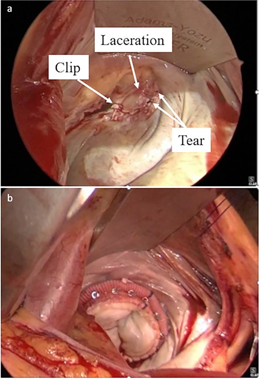 Intraoperative findings during minimally invasive mitral valve replacement. (a) Prolapse of the A3 segment and two tears in the P3 segment were observed. (b) Valve replacement was performed using a 29-mm Epic bioprosthesis.